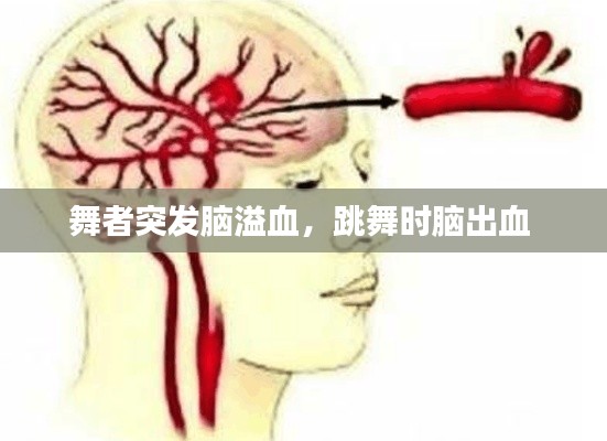 舞者突發(fā)腦溢血，跳舞時腦出血 
